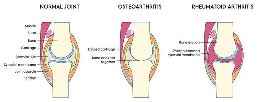 Rheumatoid Arthritis